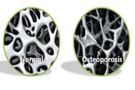 Bergerak Kurangi Risiko Osteoporosis