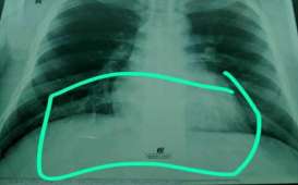 Waspada Virus Corona, Kenali Happy Hypoxia