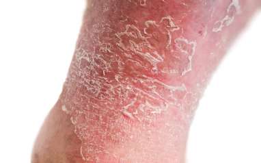 Kulit Eksim dan Psoriasis, Ini Cara Merawatnya