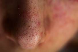 6 Kebiasaan yang Bisa Memicu Penyakit Telinga Hidung Tenggorokan atau THT