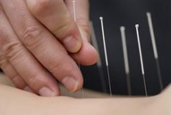  Studi: Akupunktur aman buat anak-anak