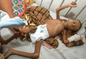  17% Balita di Kota Tasik alami gizi buruk