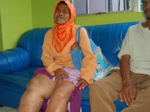  WABAH PENYAKIT: 6 Warga Cimahi Kena Filariasis