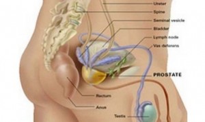  KESEHATAN: Kanker Prostat Beda-beda Pengobatannya