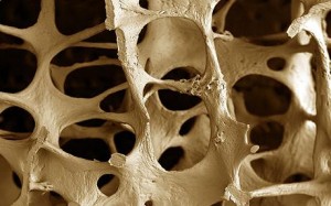  Osteoporosis Bisa Dicegah Sejak Dini