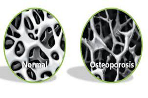  Bergerak Kurangi Risiko Osteoporosis