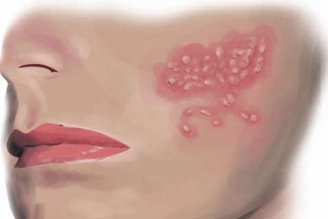  RISIKO PENYAKIT: Saat Herpes Zoster  Menyerang