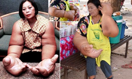  Wanita Ini Memiliki Tangan Seberat 10 KG