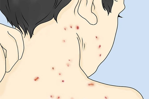  Awas, Virus \'Zombi\' Herpes Zoster Bangkit Lagi!