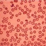  Cara Antisipasi Penyakit Thalasemia