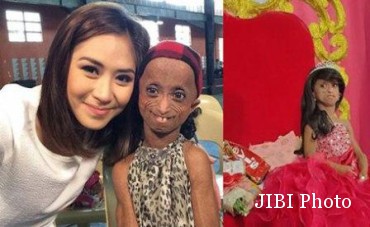  Gadis 18 Tahun Berwajah Nenek Karena Penyakit Langka