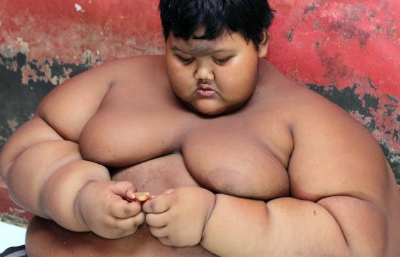  Arya, Bocah Obesitas Tinggalkan RSHS