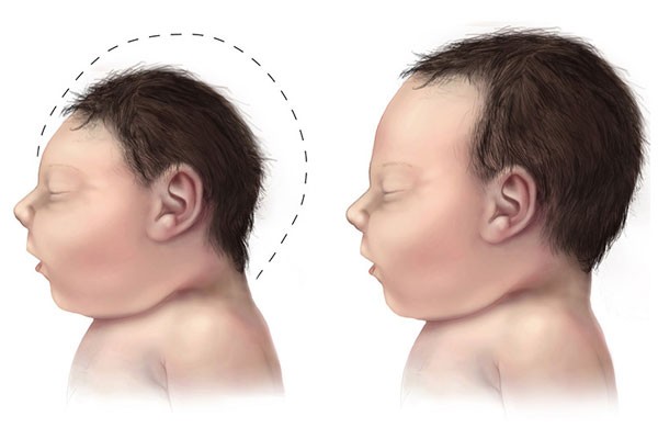  Virus Zika Bisa Menular Lewat Air Mata