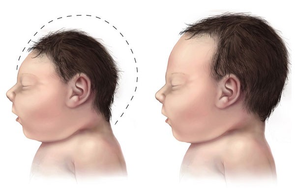  3 Kasus Zika Terdeteksi di Vietnam