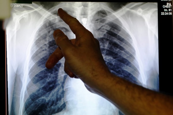  ARIFIN PANIGORO: Kasus TB Belum Sepenuhnya Jadi Perhatian Masyarakat