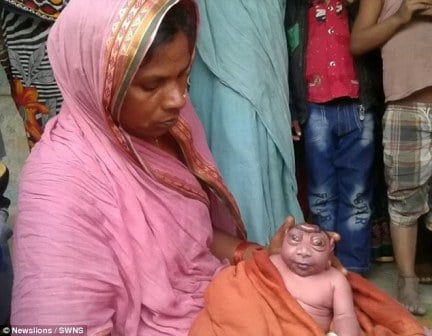  Kelainan Genetik, Bayi Lahir di India Mirip Alien