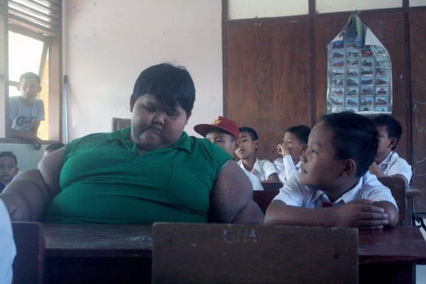  Kapan Anak Obesitas Harus Jalani Bedah Bariatrik?