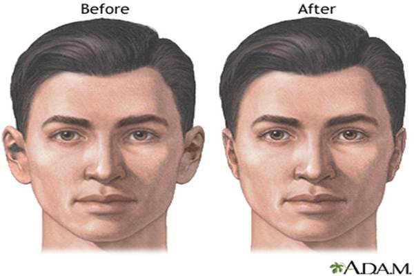Reshaping wajah/Ilustrasi