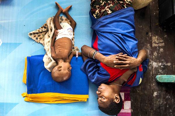  Penderita Gizi Buruk di Asmat, Papua