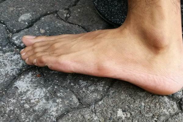  Mengenali Gejala Penyakit Lupus Bisa Dimulai dari Kulit, Simak Penjelasannya