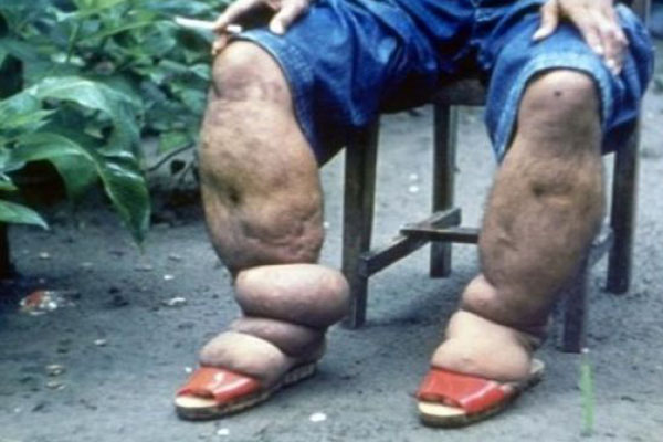  Kaki Gajah di Papua Barat, Warga Diimbau Ikut Gerakan Eliminasi