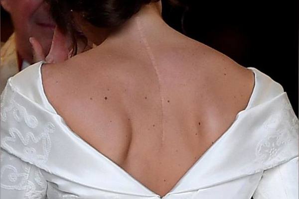  Royal Wedding, Putri Eugenie Tampakkan Bekas Luka Operasi