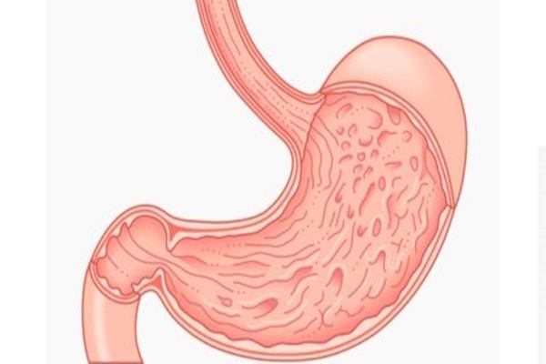  Turunkan Berat Badan dengan Teknik Mengecilkan Lambung