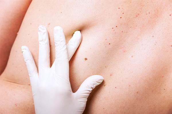  Kasus Kejadian Melanoma Meningkat Pada Pria Muda