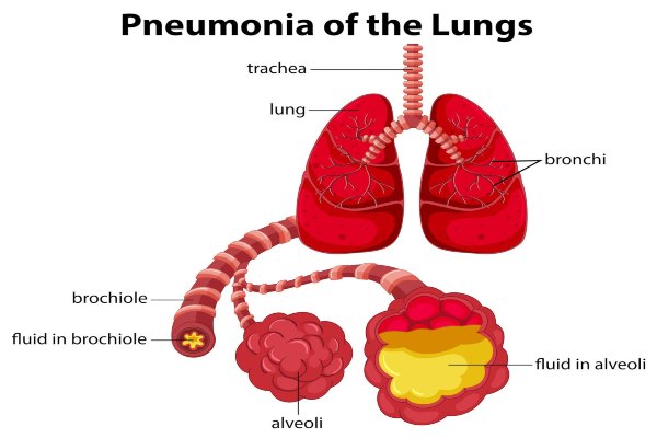  Wabah Pneumonia Misterius China Dikaitkan dengan Virus Corona Baru
