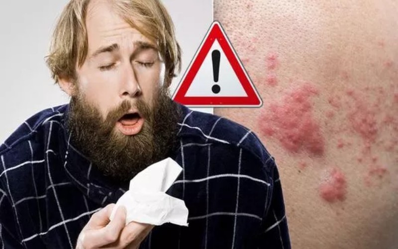  Bintik Merah Disertai Gatal Jadi Gejala Baru Virus Corona