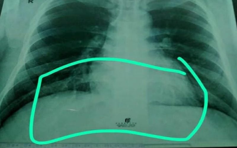  Kisah Adik Via Vallen Positif Covid-19, Hasil Rapid Test Non Reaktif