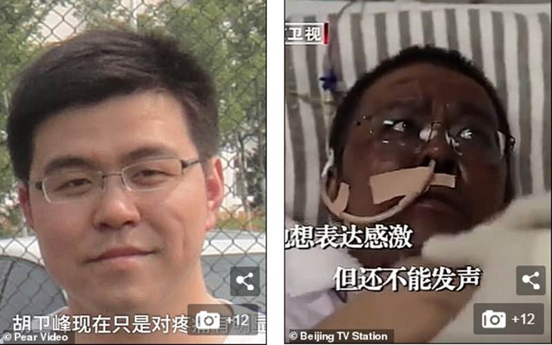  Dokter Wuhan yang Kulitnya Berubah Saat Pengobatan Covid-19 Akhirnya Meninggal
