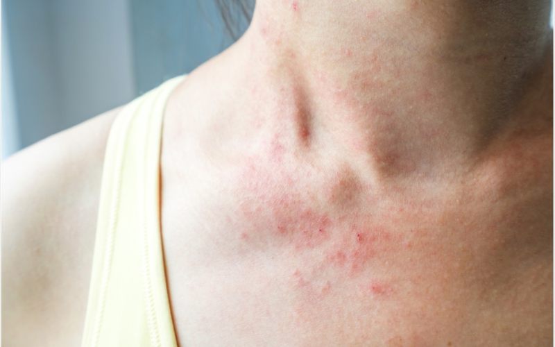 Ruam merah padda kulit menjadi gejala baru virus corona (Covid-19)./News Medical