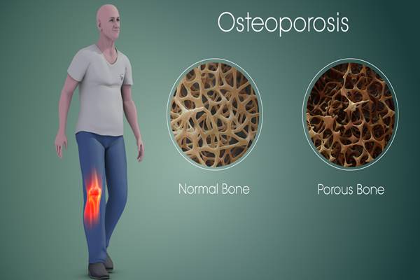  PENYAKIT DEGENERATIF : Mendiagnosis Osteoporosis