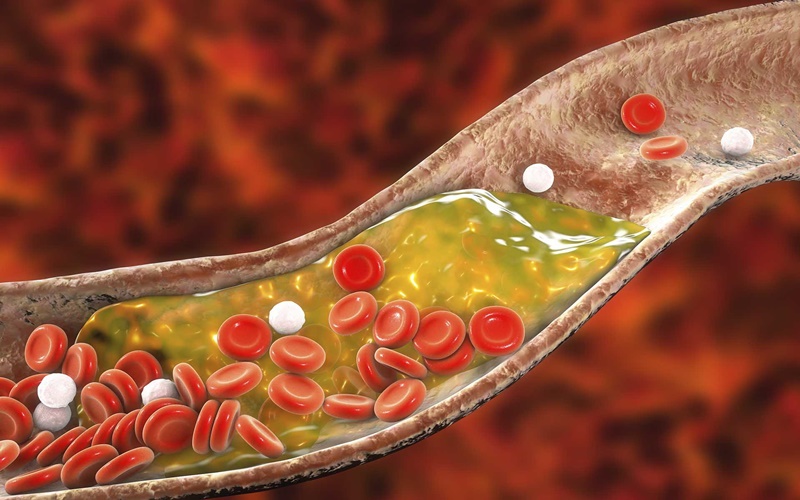  10 Cara Turunkan Kolesterol Secara Alami, Tanpa Obat