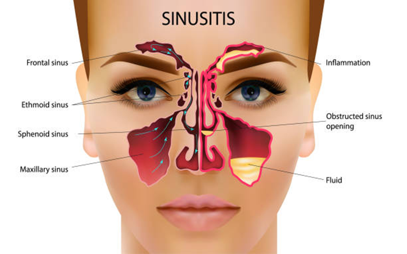  Makanan yang Harus Dikonsumsi dan Dihindari Penderita Sinus