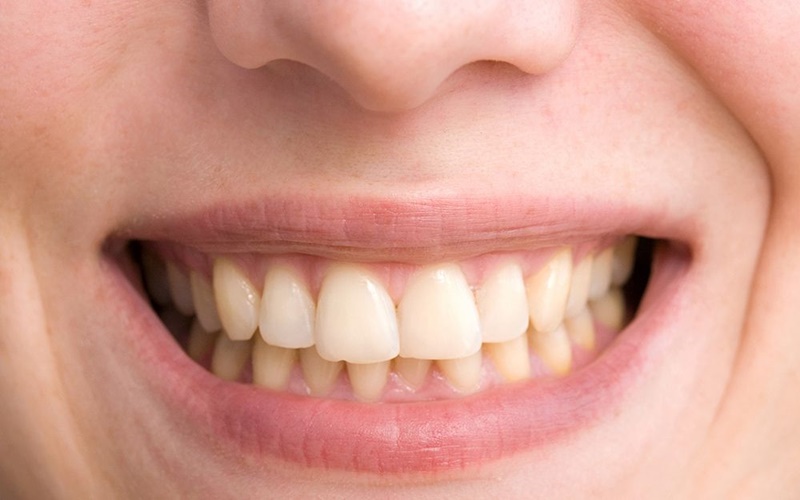  Mengenal Bruxism, Kebiasaan Menggemeretakkan Gigi yang Disebabkan Stres