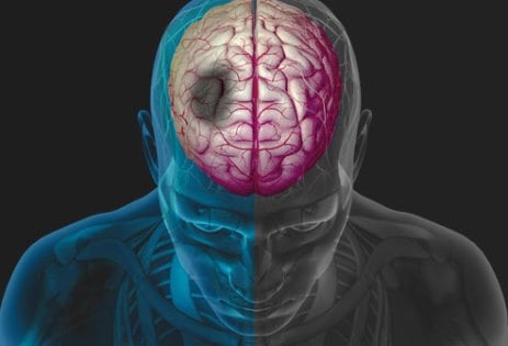  Hati-hati Buat Anda yang Kolesterol Tinggi, Sakit Kepala Bisa Mengindikasikan Stroke