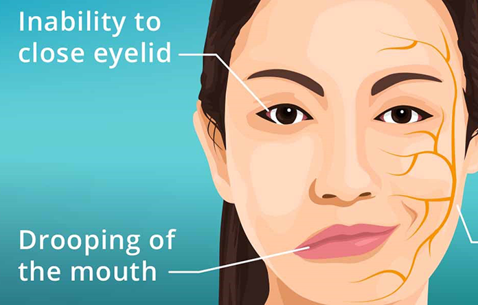  Studi: Bell’s Palsy Pasca Vaksin Covid Masih Sangat Jarang Terjadi
