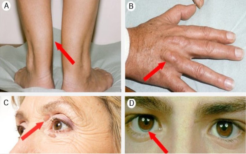  Awas Kolesterol Tinggi! Cek Tandanya di Tangan, Lutut, dan Hidung