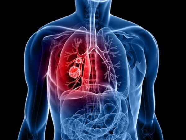 Tanda-tanda Kanker Paru-paru di Jari, Wajah, Leher dan Bahu Anda