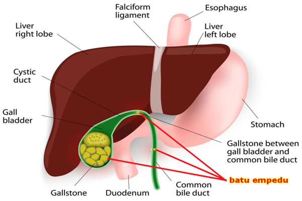  Gejala Batu Empedu dan Penyebabnya