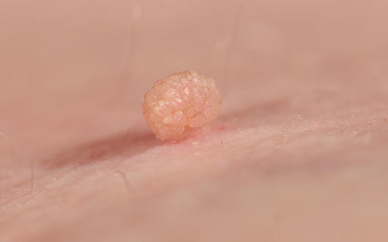 Skin tag/clevelandclinic.org
