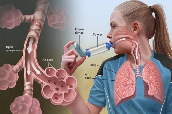 Penyakit asma/Istimewa
