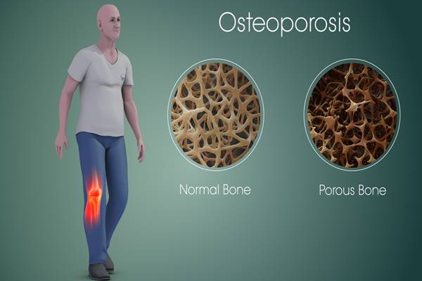 Pengeroposan tulang (osteoporosis)/Istimewa