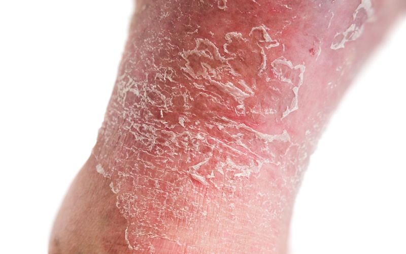  Kenali 5 Jenis Artritis Psoriatik, Penyakit Kulit Langka Disertai Nyeri Sendi