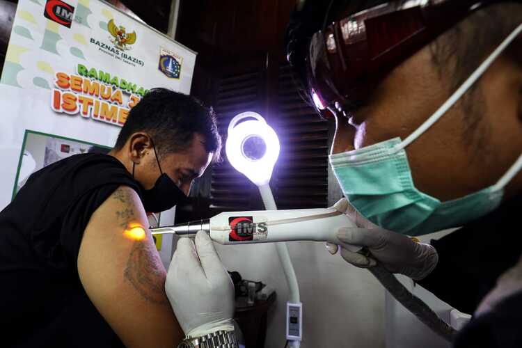  Program Hapus Tato Gratis Target 100 Pasien