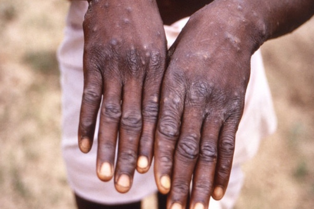  Spanyol Konfirmasi 30 Kasus Cacar Monyet (Monkeypox), Terkait Sauna Pria
