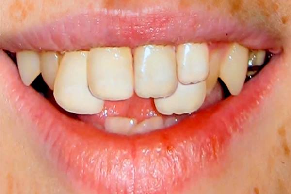  Kenali Apa Itu Gingivitis, Penyebab, Gejala, Hingga Pengobatan