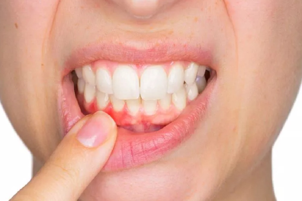  Penyebab dan Cara Mencegah Gingivitis, Jangan Anggap Enteng!